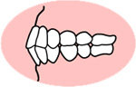 上下顎前突（じょうげがくぜんとつ）