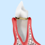 レベル1　歯肉炎
