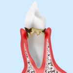 レベル2　軽度歯周炎